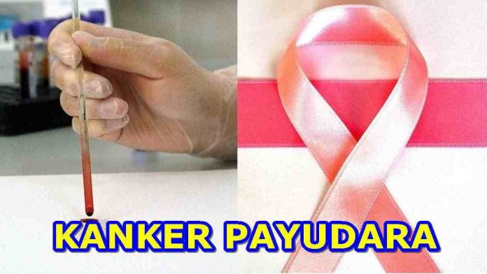 Deteksi dini kanker payudara