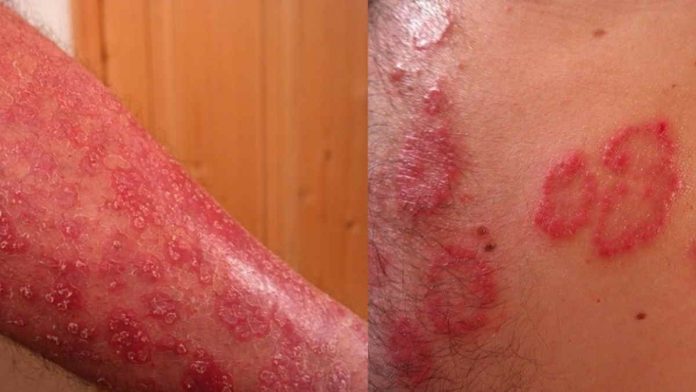 Obat Kudis Alami