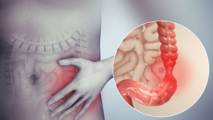 Pengobatan Irritable Bowel Sindrome secara Alami