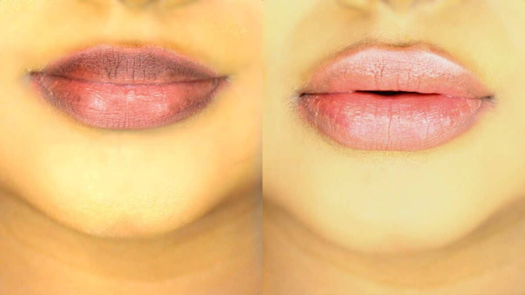 Cara Menghilangkan Bibir Hitam