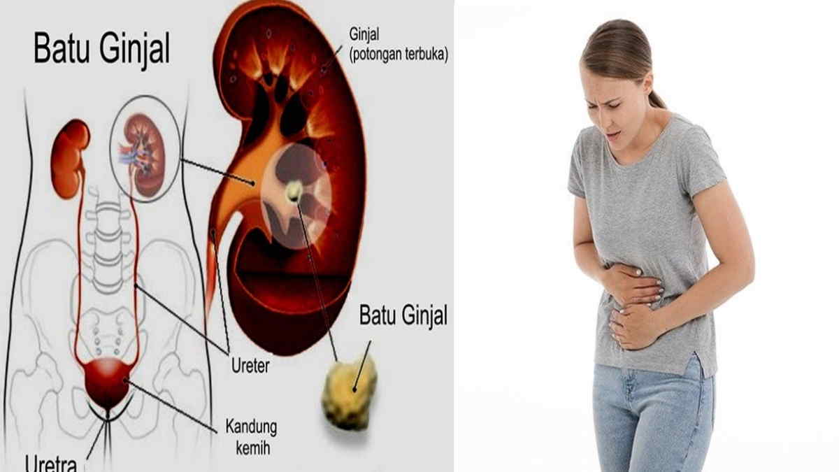 Ciri batu ginjal