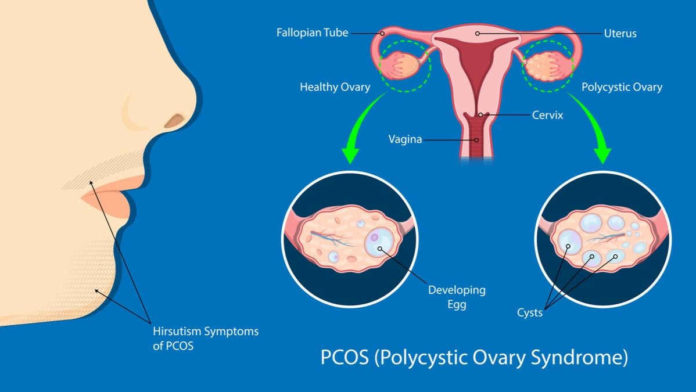Cara Mengatasi Penyakit PCOS dengan Pola Hidup Sehat