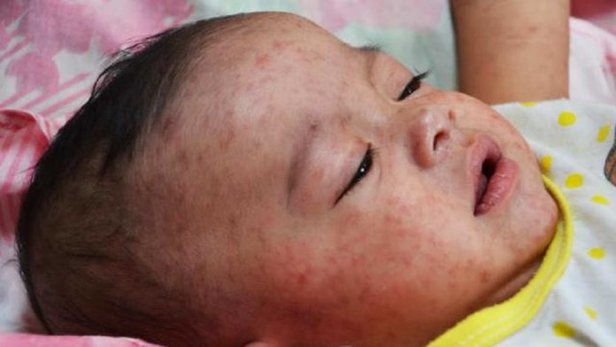Gejala Campak Pada Anak Wajib Anda Tahu Sebelum Terlambat