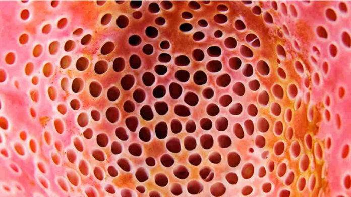 Cara Menghilangkan Trypophobia Sesuai dengan Penyebabnya