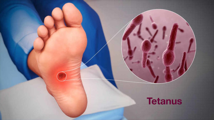 Penyebab Penyakit Tetanus, Gejala Hingga Cara Pengobatan yang Tepat