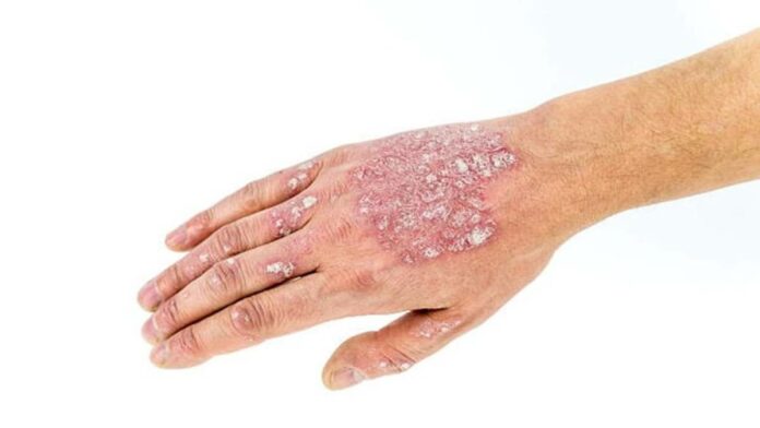 Penyakit Kulit Psoriasis, Pahami