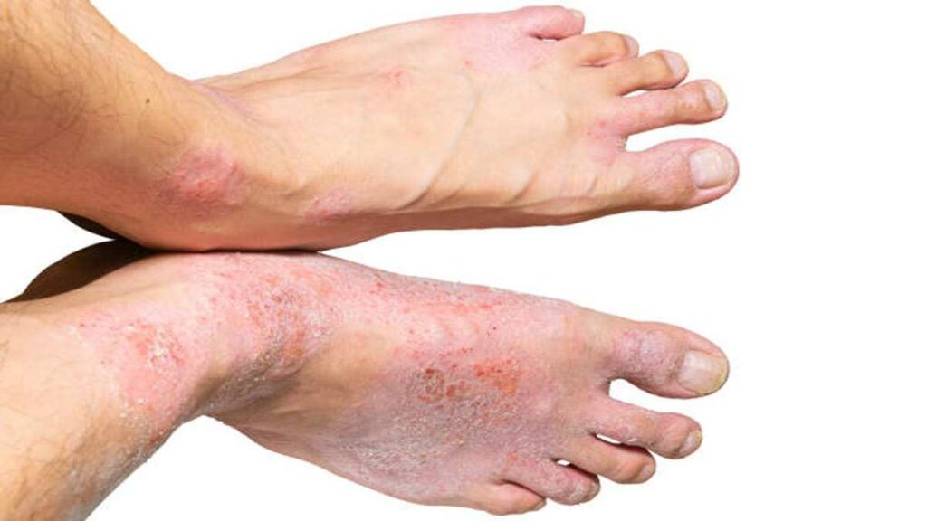 Penyakit Kulit Psoriasis