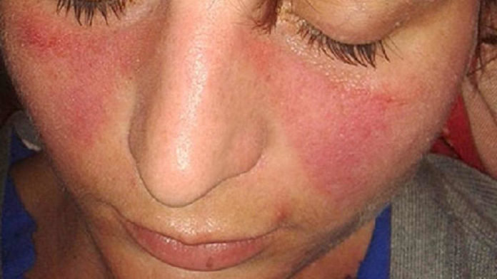 Lupus Eritematosus Sistemik Penyakit Autoimun yang Mematikan
