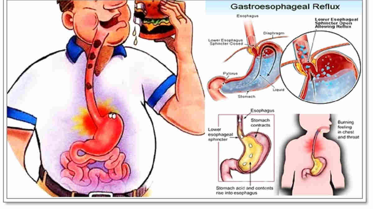 Penyakit Refluks Gastroesofagus, Gejala dan Cara Mengatasinya