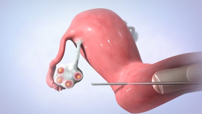 Fertilisasi In Vitro Program Bayi Tabung Solusi Untuk Masalah Pernikahan
