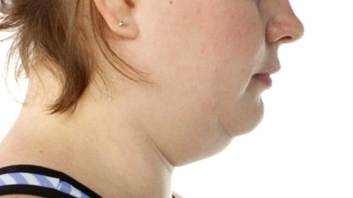 Cara menghilangkan double chin atau dagu ganda bisa kamu lakukan dengan mudah dan aman tanpa ada efek samping. Foto: Net/Ist.
