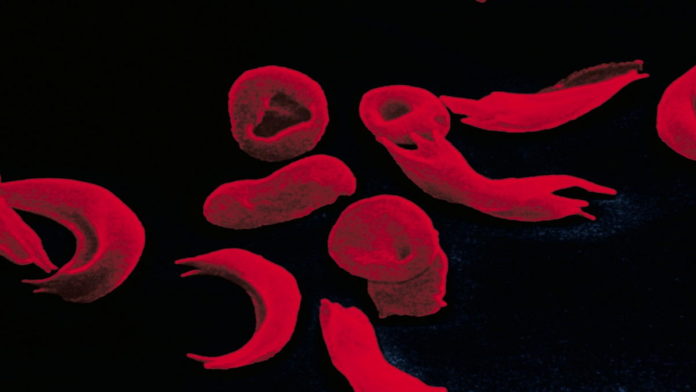 Anemia Sel Sabit, Ketahui Penyebab, Gejala dan Cara Mendiagnosisnya!