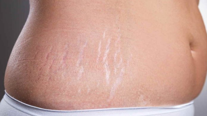 Cara Menghilangkan Stretch Mark Termudah Menggunakan Bahan Alami