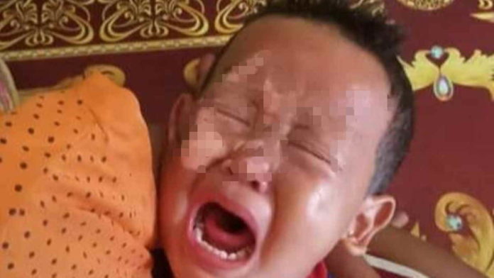 Bocah di Tasikmalaya Alami Luka Bakar Serius di Wajah