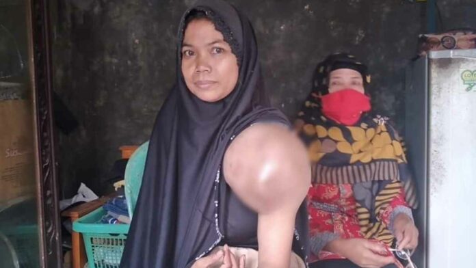 Penderita Tumor di Ciamis