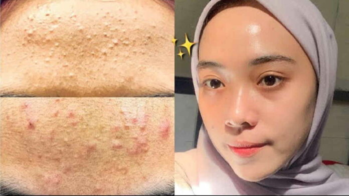 Pelembab untuk Kulit Bruntusan Bersihkan Wajah Secara Efektif