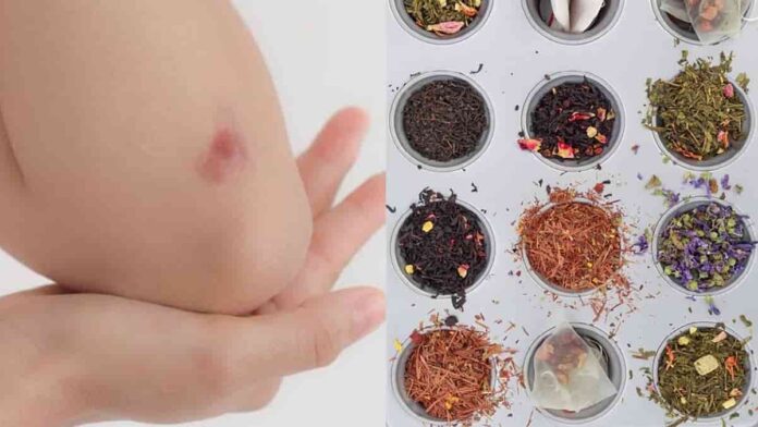 cara menghilangkan keloid