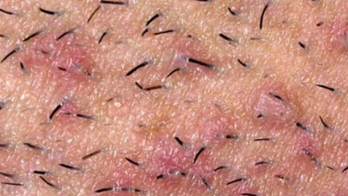 Penyebab dan Cara Mengatasi Rambut Tumbuh ke Dalam