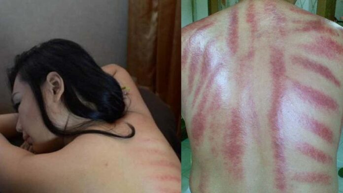efek kerokan saat masuk angin