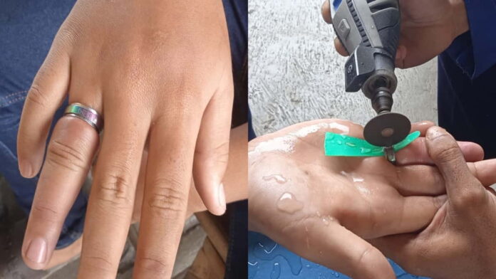 Jari Bengkak karena Cincin Stainless