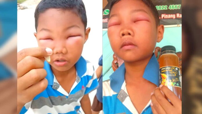 Mata Anak Disengat Tawon