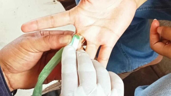 Cincin nyangkut