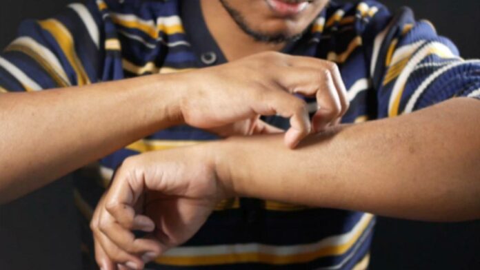 Cara Mengatasi Gatal-gatal Alergi, Jenis dan Mencegahnya