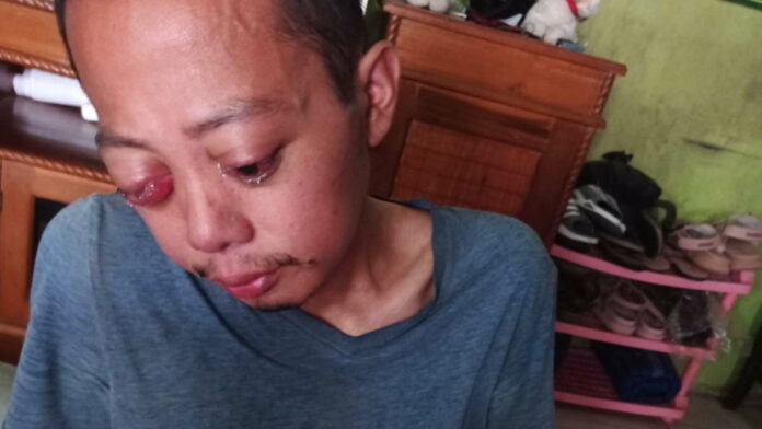 Penderita Tumor Mata di Pamarican Ciamis Butuh Bantuan untuk Pengobatan