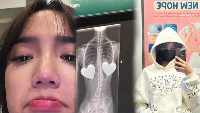 Fuji Mengidap Sakit Skoliosis