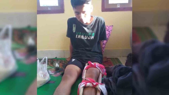 Patah Kaki
