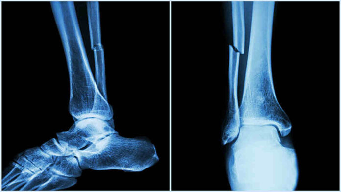 Anatomi Tulang Fibula Manusia, Fungsi, Serta Ciri Khasnya