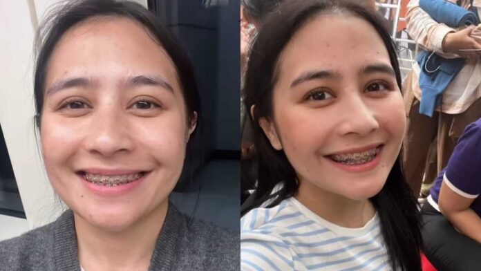 Prilly Latuconsina Pasang Behel