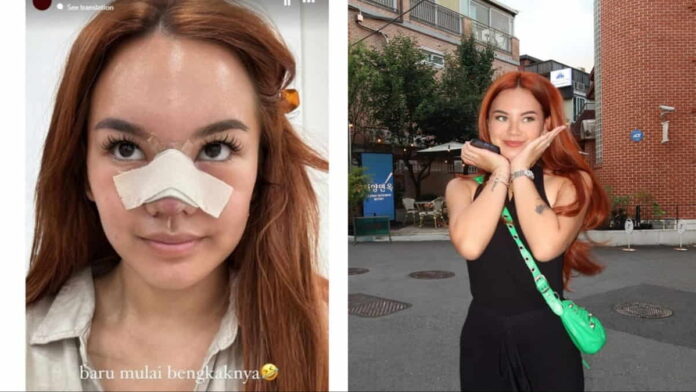 Shafa Harris Operasi Plastik