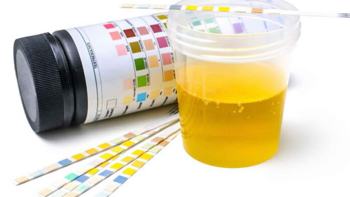 Klasifikasi Protein Urine, Normal dan Proteinuria