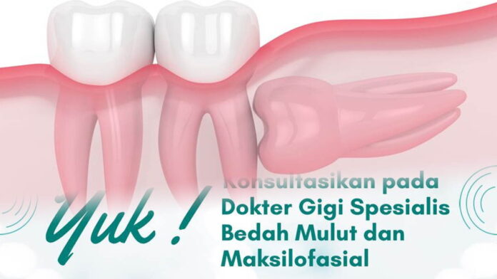 Memahami Penyebab dan Gejala Impaksi Gigi Menurut Dokter RSUD Pandega Pangandaran